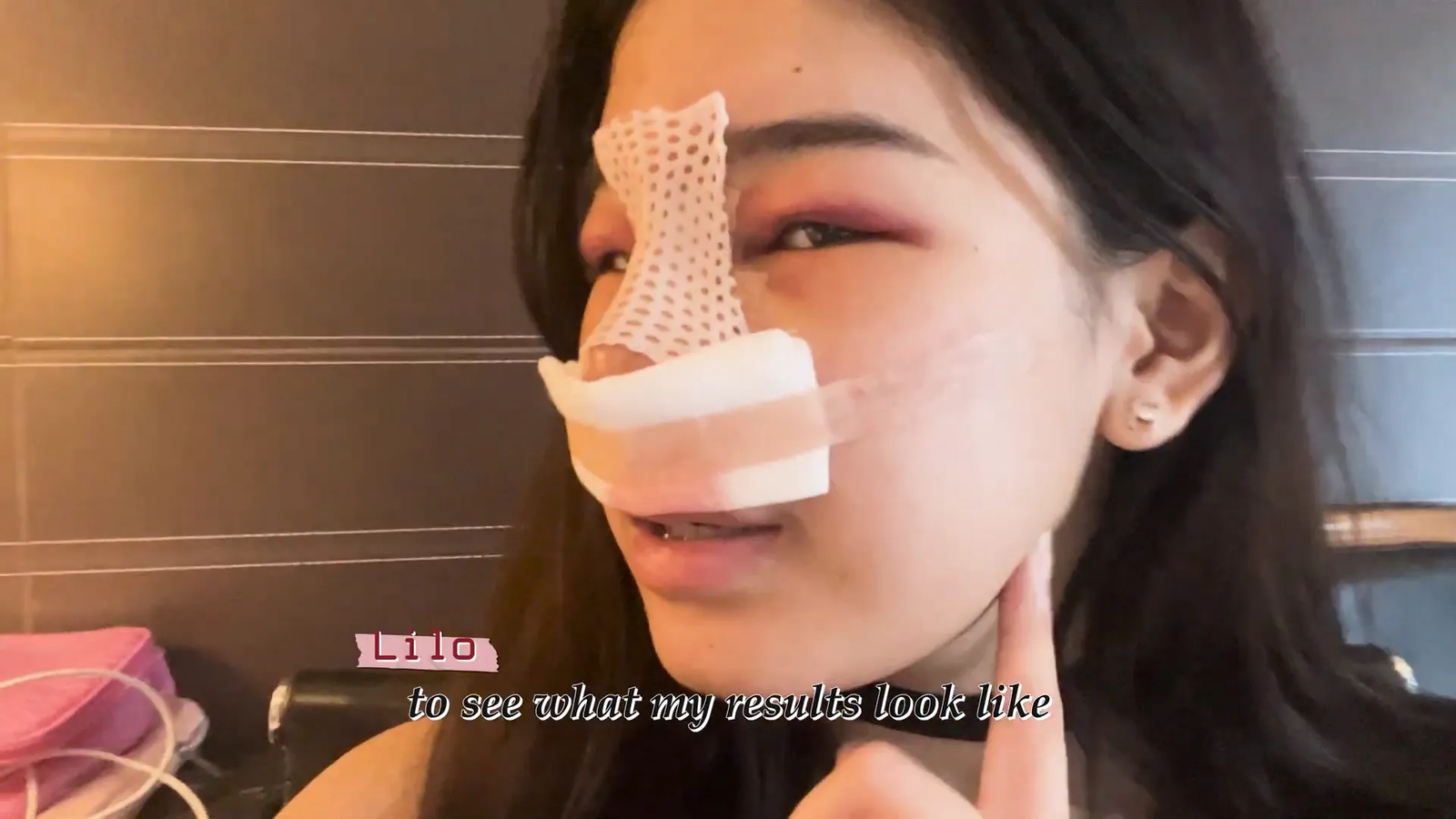 תהליך ההחלמה לאחר ניתוח האף